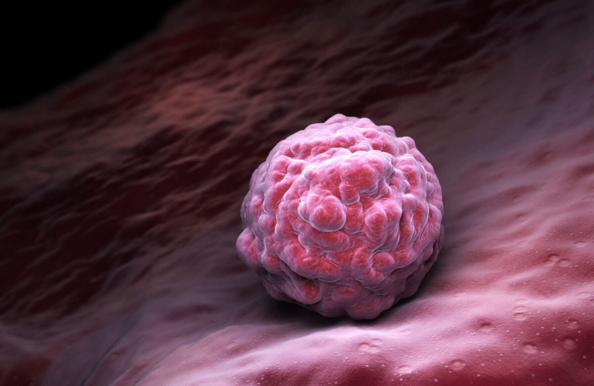 Fledgling AI trial spots breast cancer missed by doctors