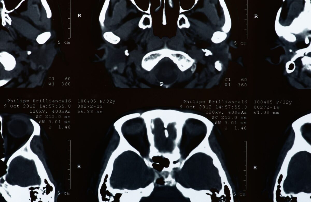 Cerebral palsy claims