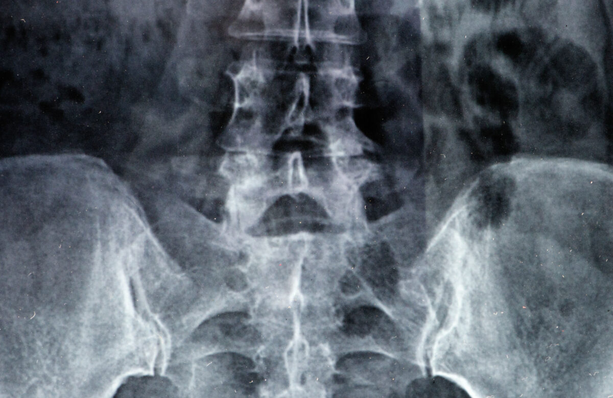 Cauda Equina Syndrome Claims